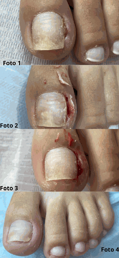 Unha Encravada (Onicocriptose)